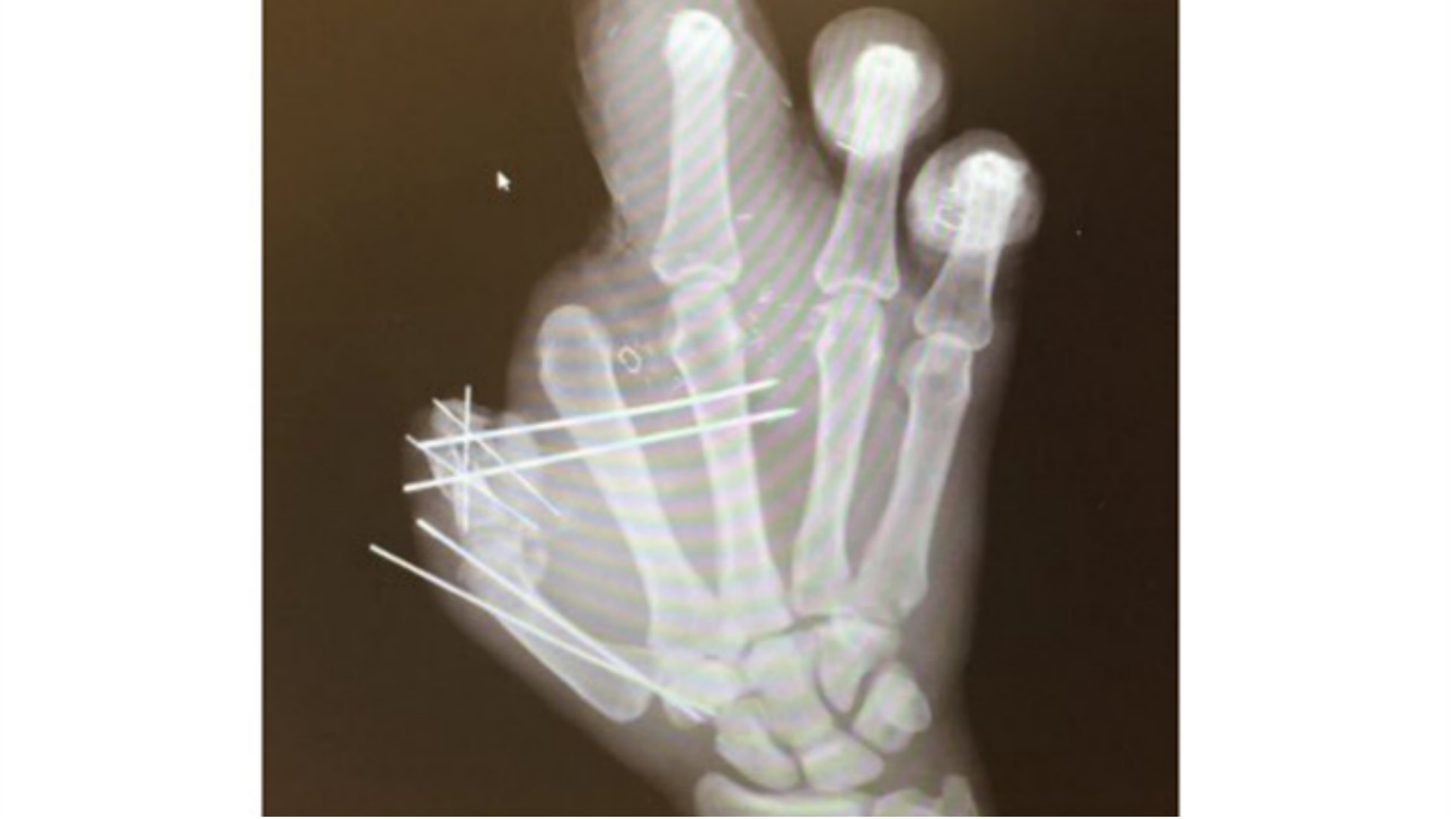 This is what an X-ray of Jason Pierre-Paul's hand looks like