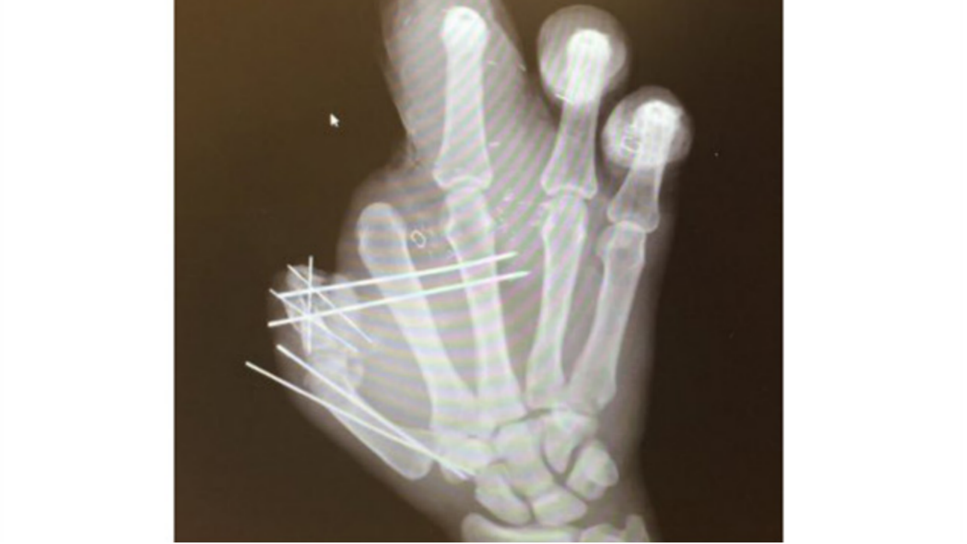 Jason Pierre-Paul shows off mangled right hand as Giants star