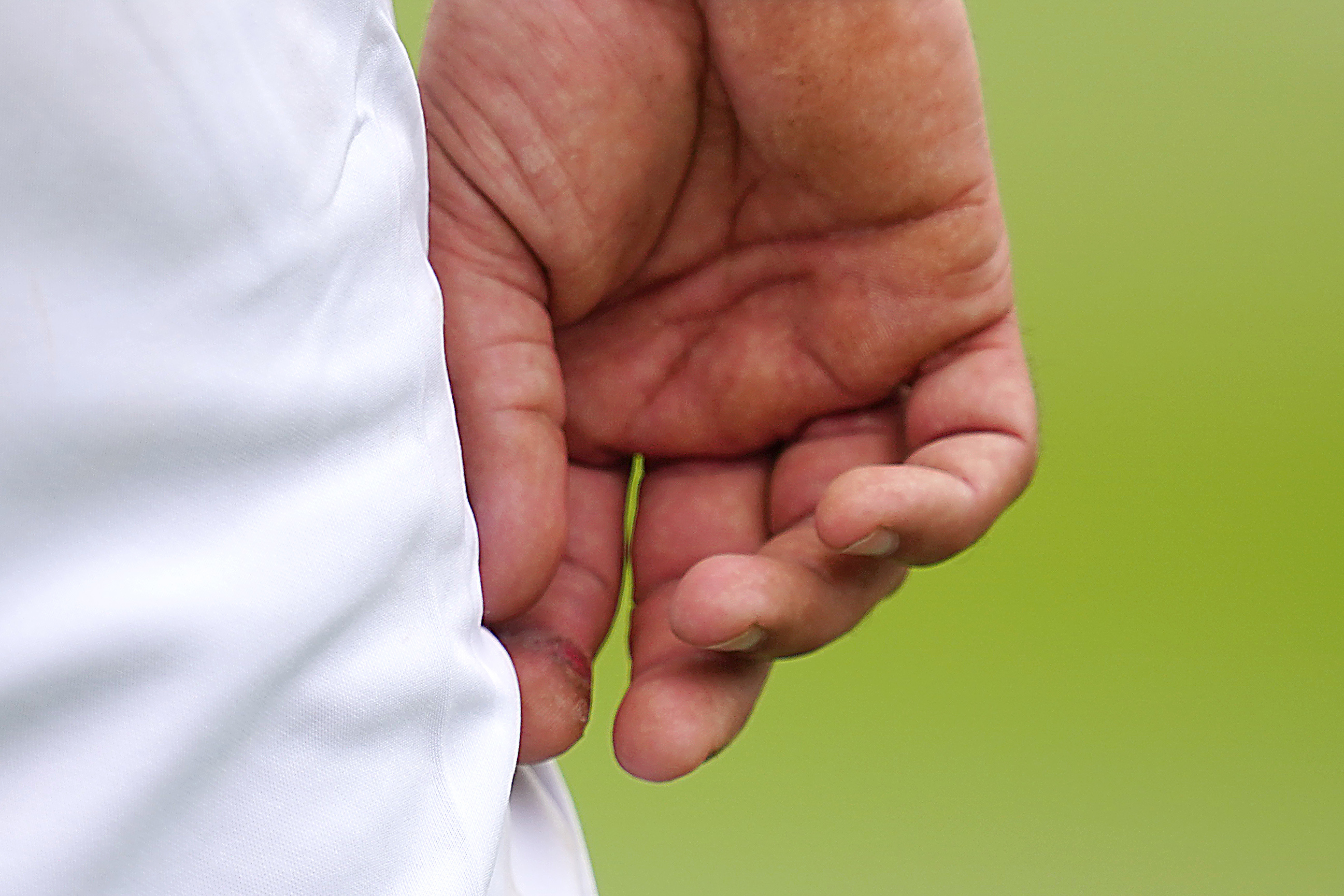Moeen Ali's index finger which had a blister during day three